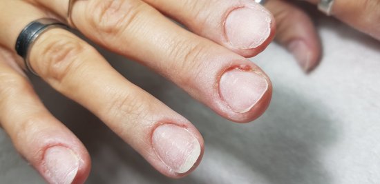 A manikűr és a beteg körömágy: miért veszélyes a túlzott kutikula-vágás?